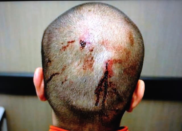 George Zimmerman's head injuries on the night that he shot and killed Trayvon Martin (courtesy Fox News)