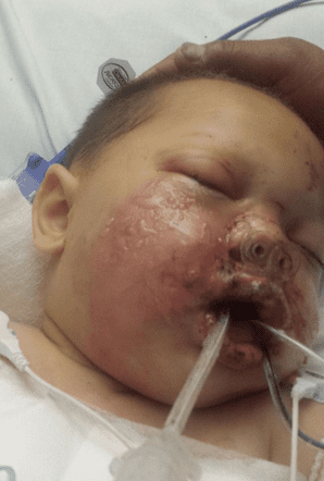 Toddler burned by stun grenade (courtesy nydailynews.com)